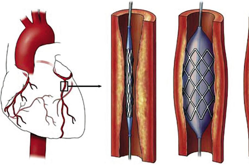 Đặt stent giúp làm thông đoạn mạch máu bị tắc nghẽn tuy nhiên đây không phải là giải pháp điều trị khỏi hoàn toàn.png